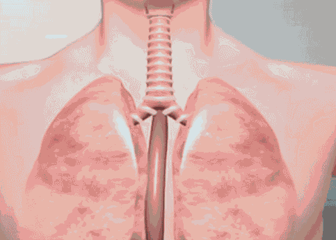 现在的肺炎是如何产生的（肺炎是怎样形成的）(2)