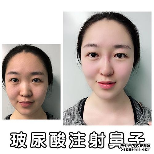 隆鼻打玻尿酸能保持多久（隆鼻用玻尿酸可靠吗）