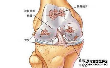 风湿关节炎怎么治疗比较好小偏方（治疗风湿性关节炎的4个实用偏方）(2)