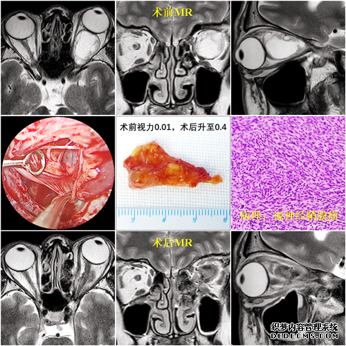 男子长成“金鱼眼”险致盲，内镜专家双人四手巧摘除